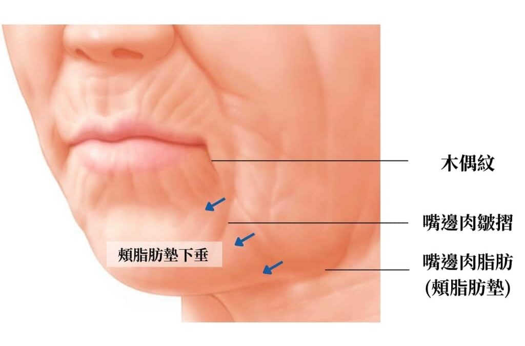 改善嘴邊肉2大方法：埋線拉提及音波